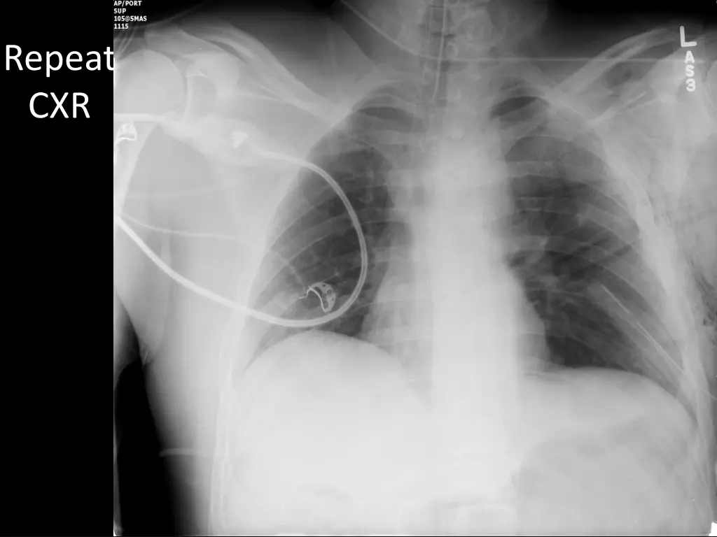 repeat cxr