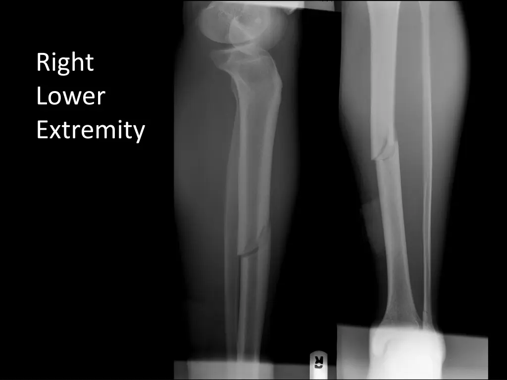 right lower extremity