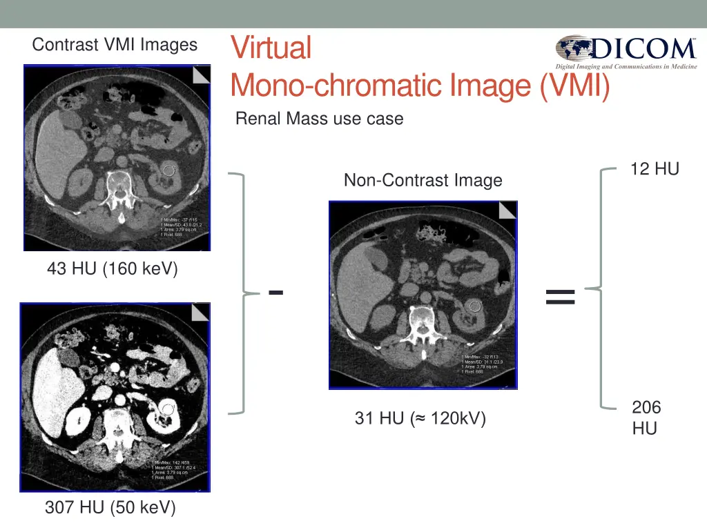 virtual mono chromatic image vmi renal mass