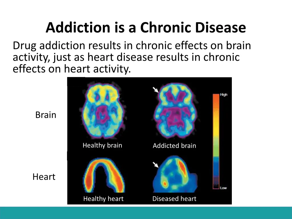 addiction is a chronic disease drug addiction