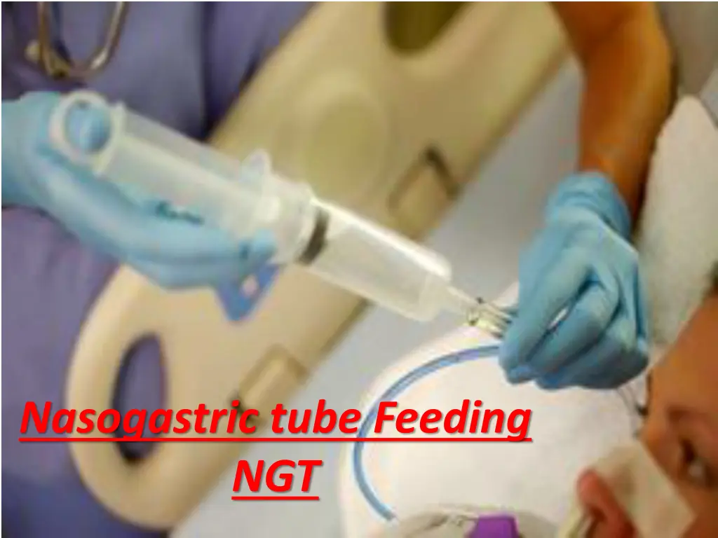 nasogastric tube feeding ngt