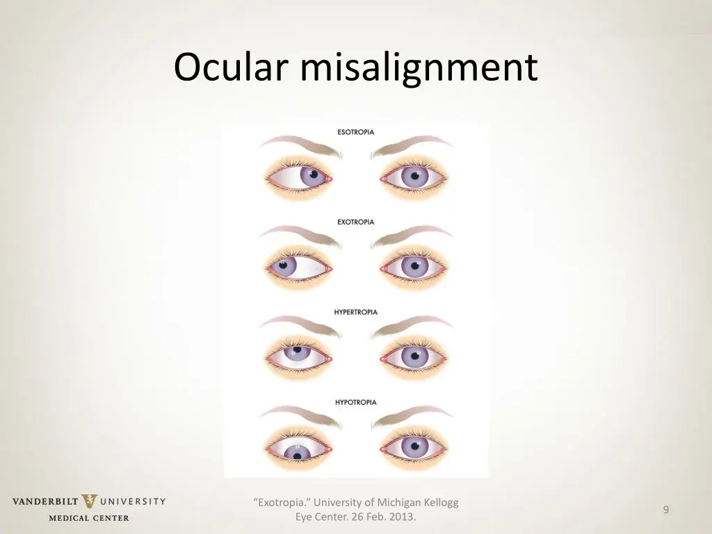 ocular misalignment