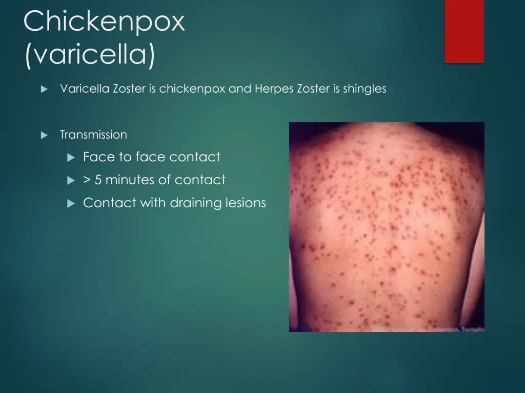 chickenpox varicella