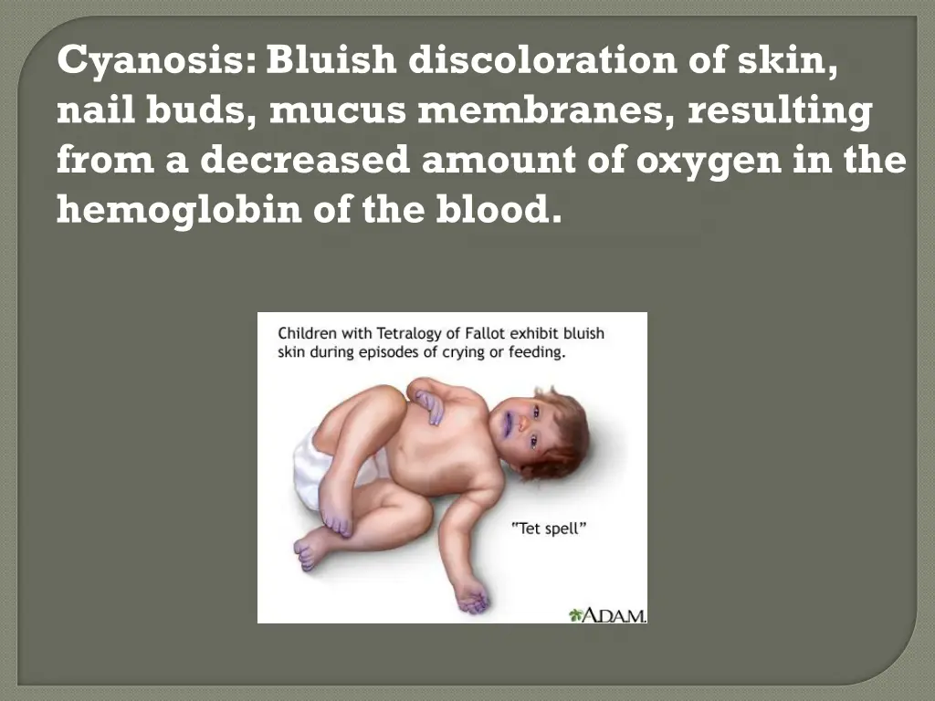 cyanosis bluish discoloration of skin nail buds