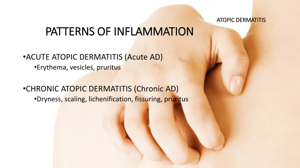 atopic dermatitis atopic dermatitis 1