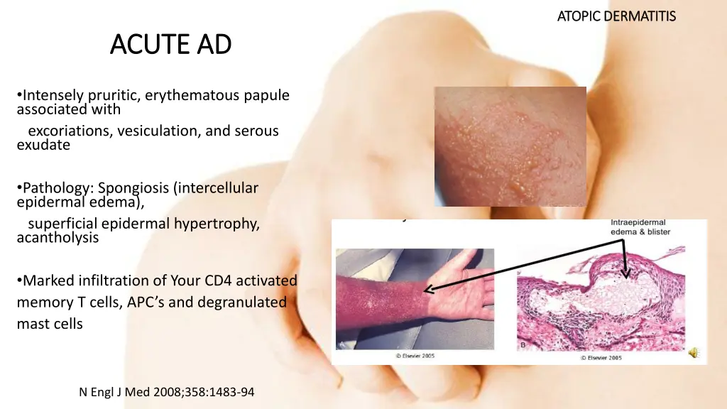 atopic dermatitis atopic dermatitis 2