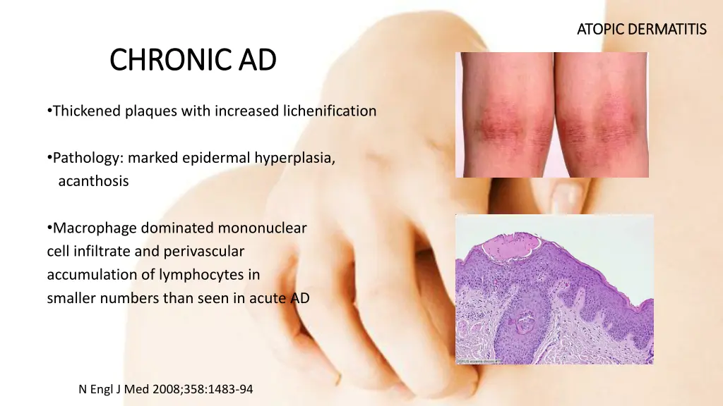 atopic dermatitis atopic dermatitis 3