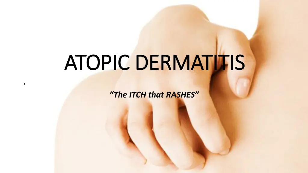 atopic dermatitis atopic dermatitis