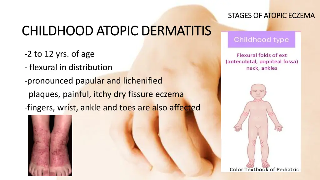 stages of atopic eczema stages of atopic eczema 1