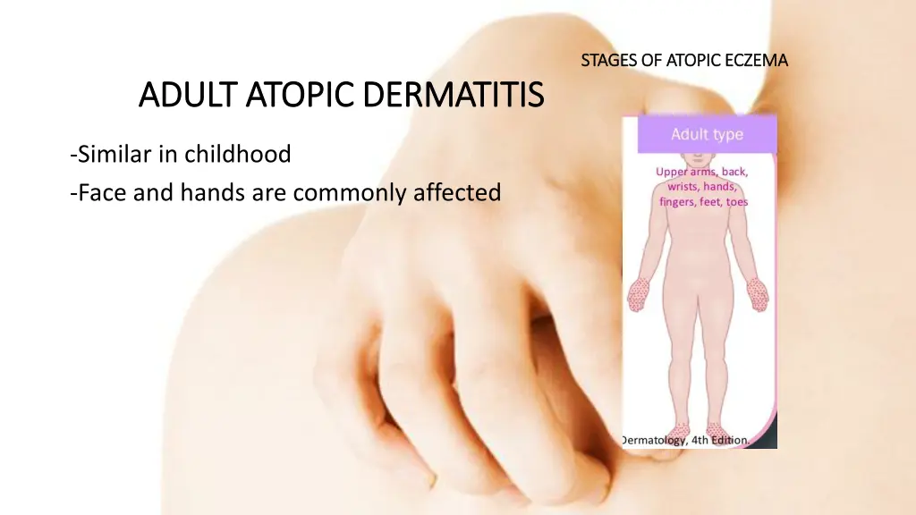 stages of atopic eczema stages of atopic eczema 2