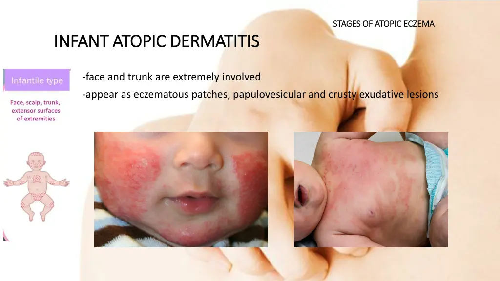 stages of atopic eczema stages of atopic eczema