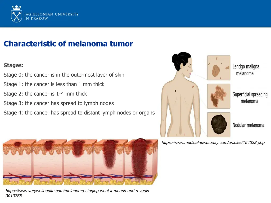 characteristic of melanoma tumor