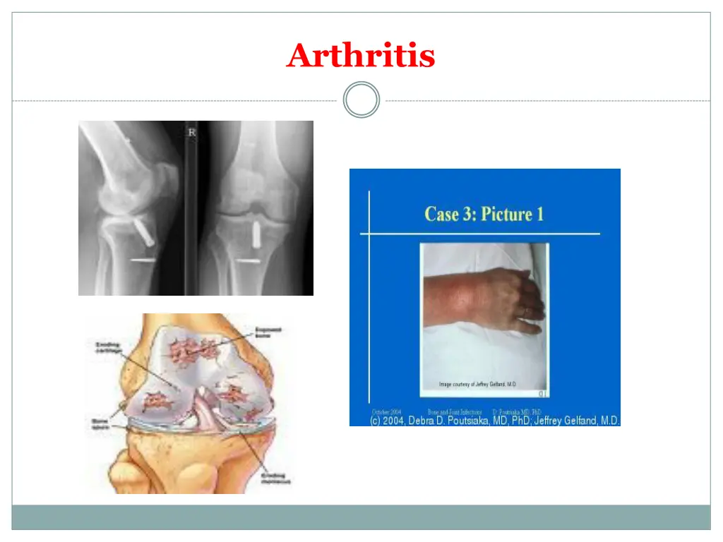 arthritis