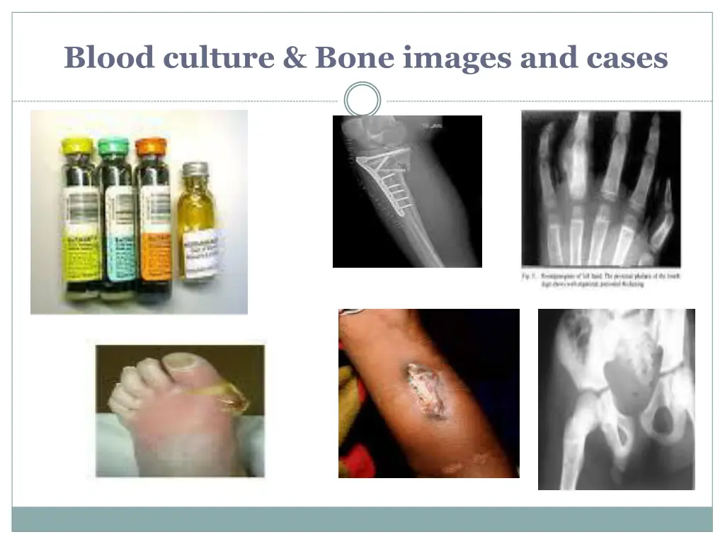 blood culture bone images and cases