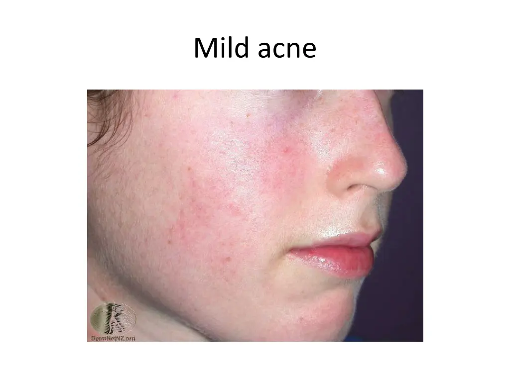 mild acne