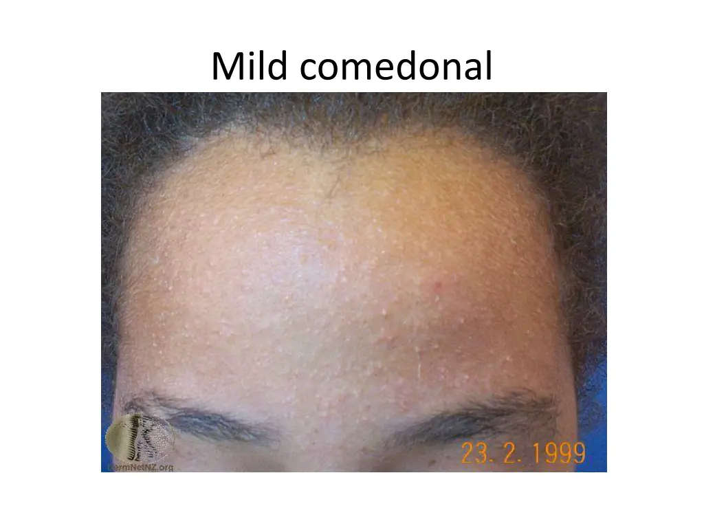 mild comedonal