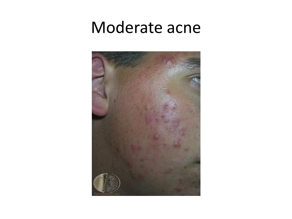 moderate acne