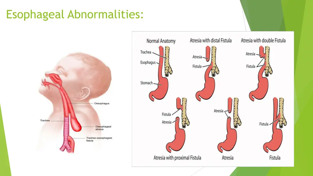 esophageal abnormalities