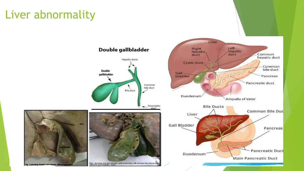 liver abnormality