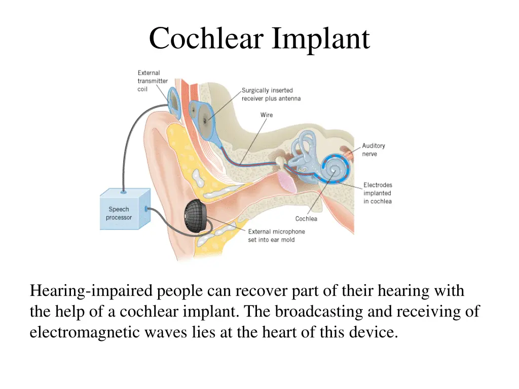 cochlear implant