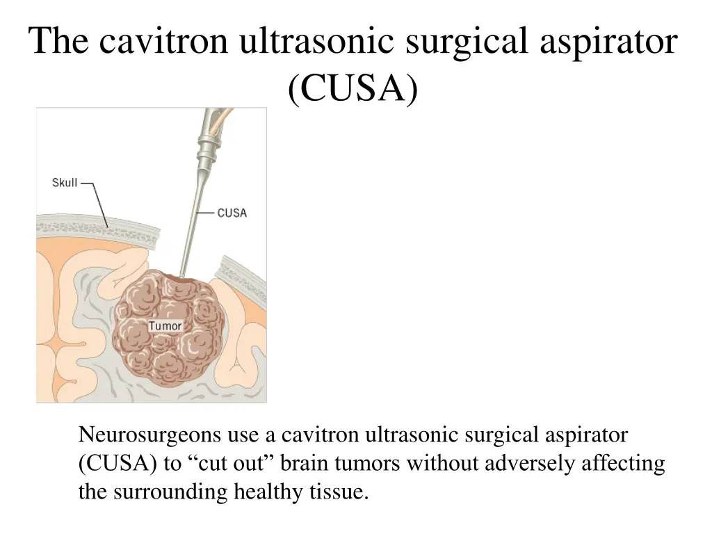 the cavitron ultrasonic surgical aspirator cusa