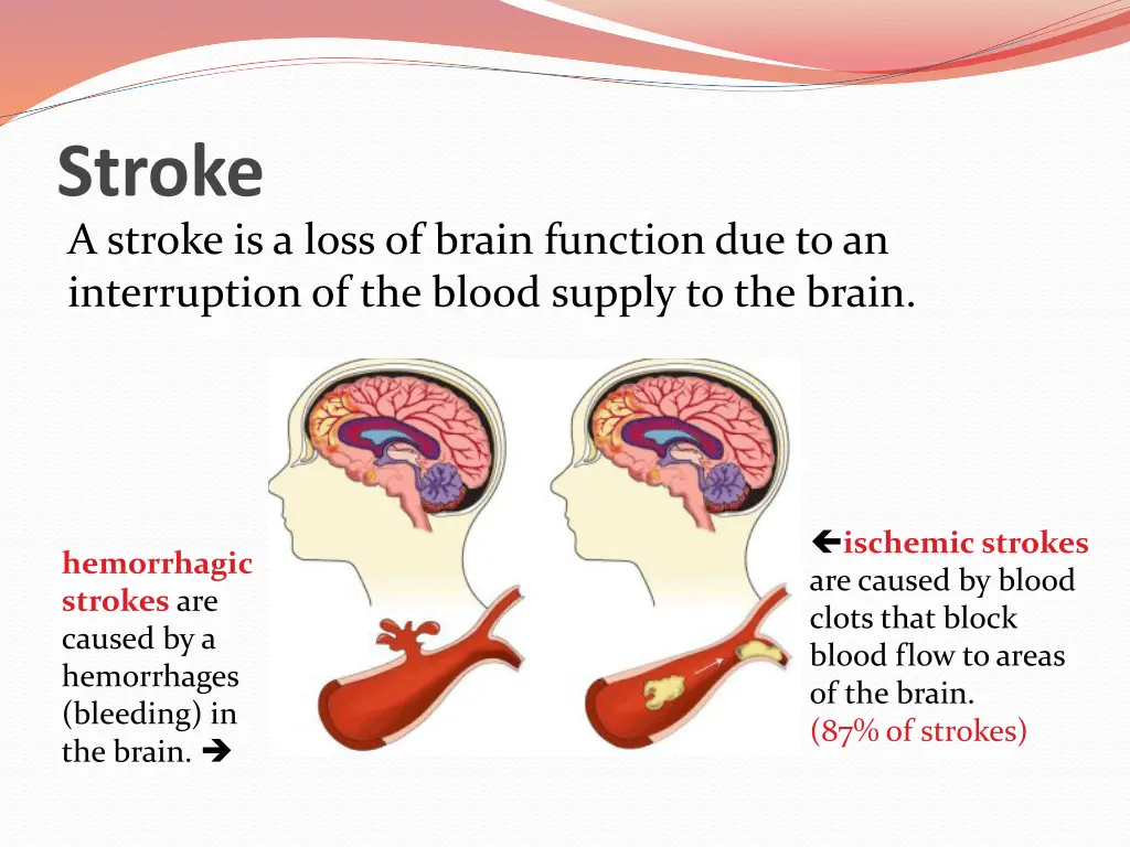 stroke a stroke is a loss of brain function