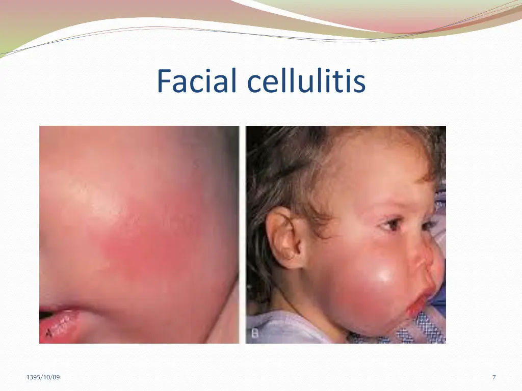 facial cellulitis