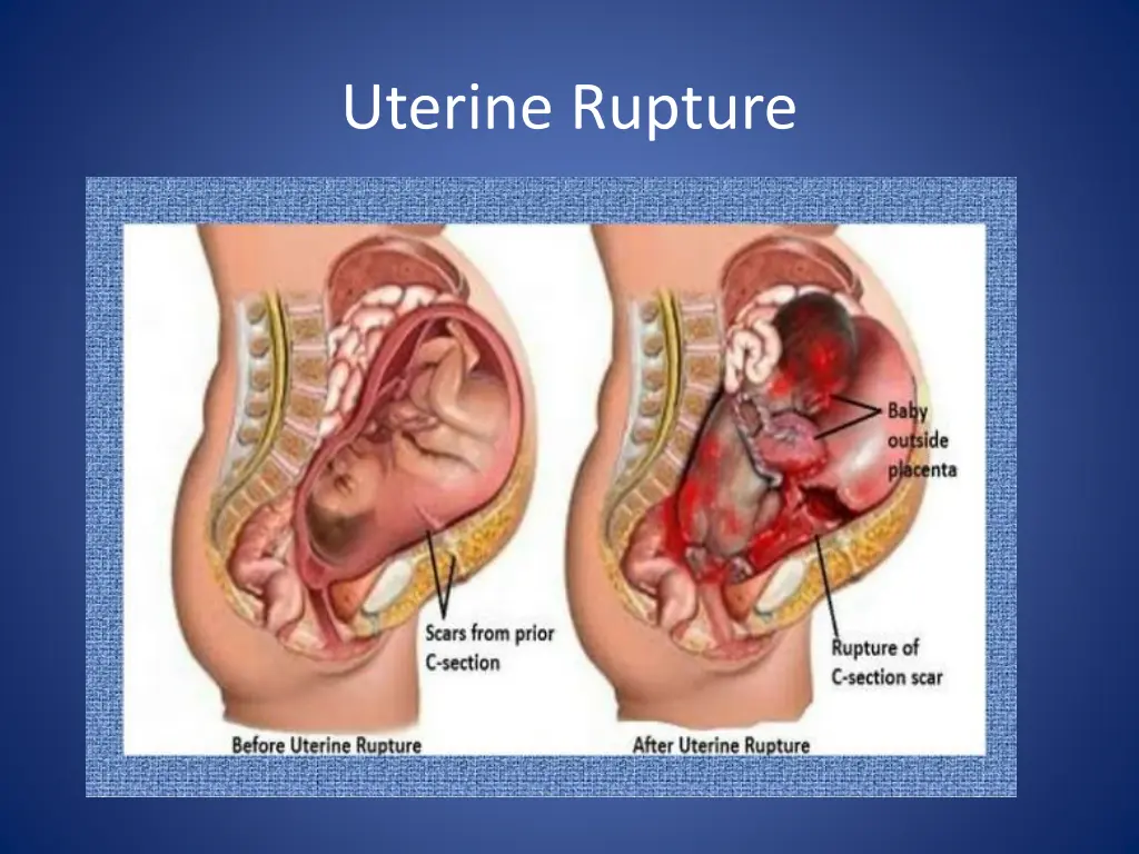 uterine rupture