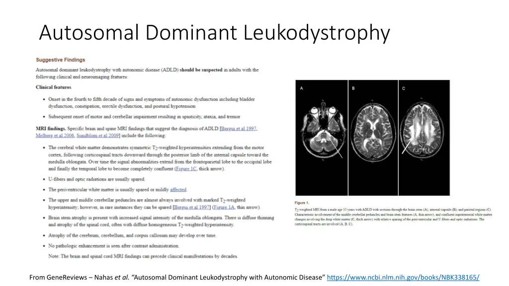 autosomal dominant leukodystrophy