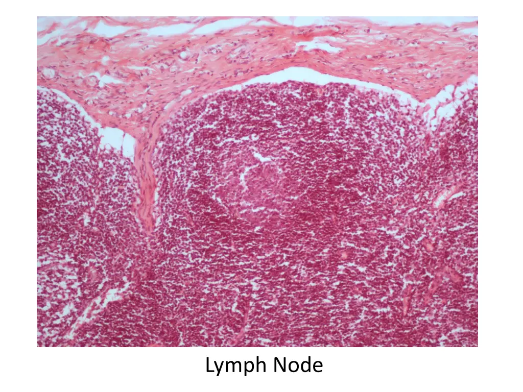 lymph node 1