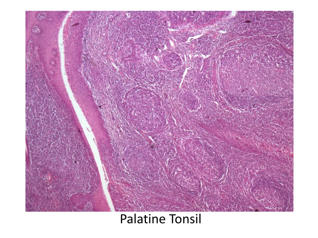 palatine tonsil 1