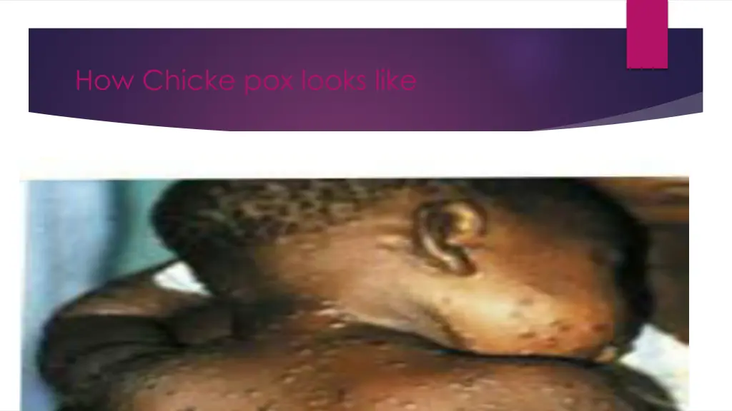 how chicke pox looks like