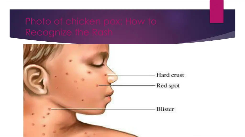 photo of chicken pox how to recognize the rash