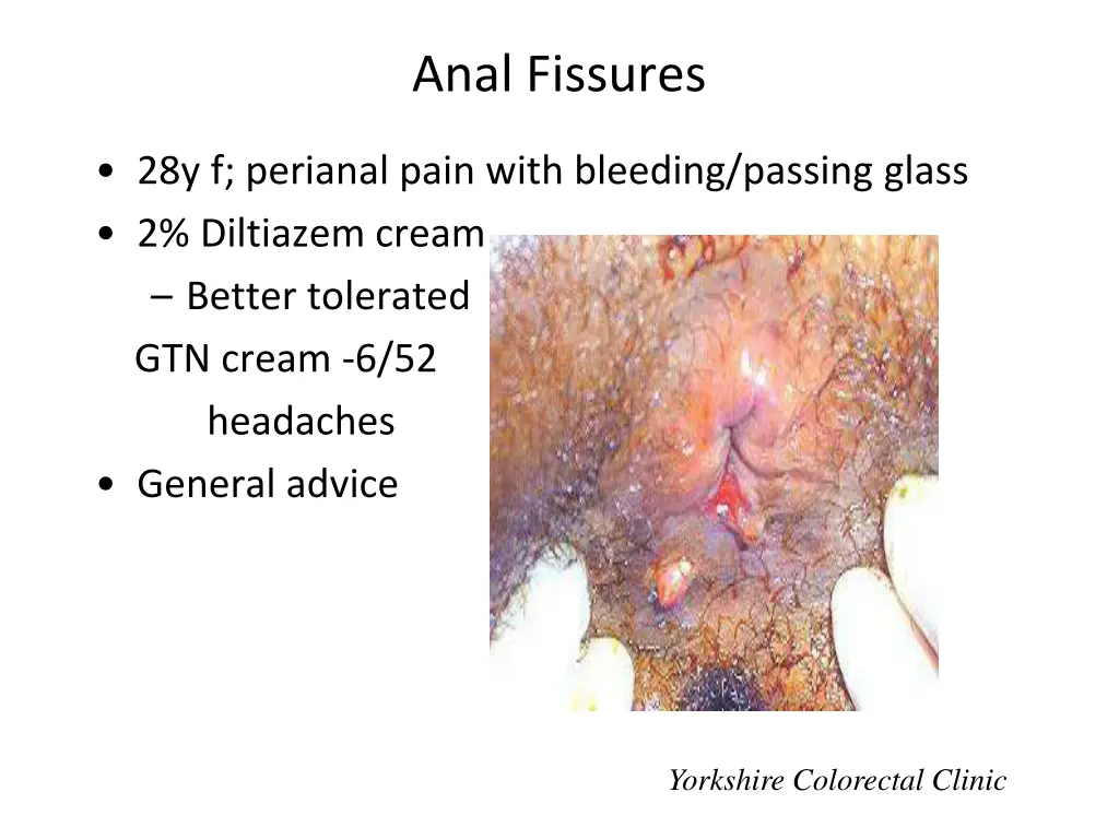 anal fissures