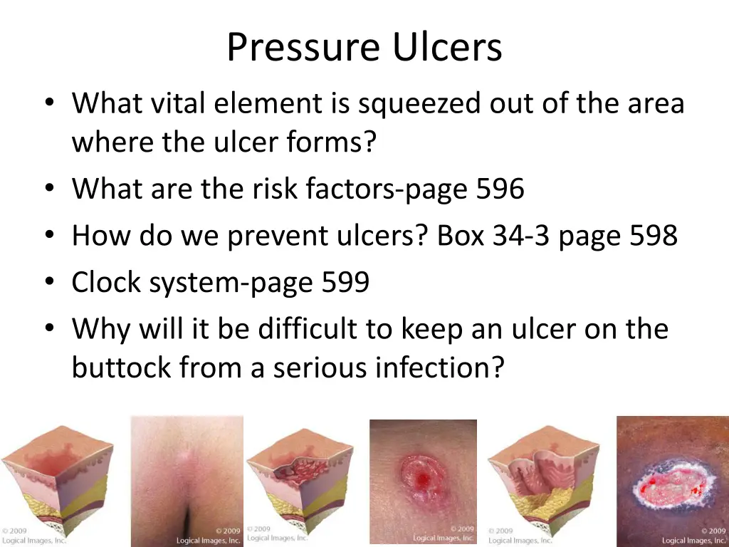 pressure ulcers