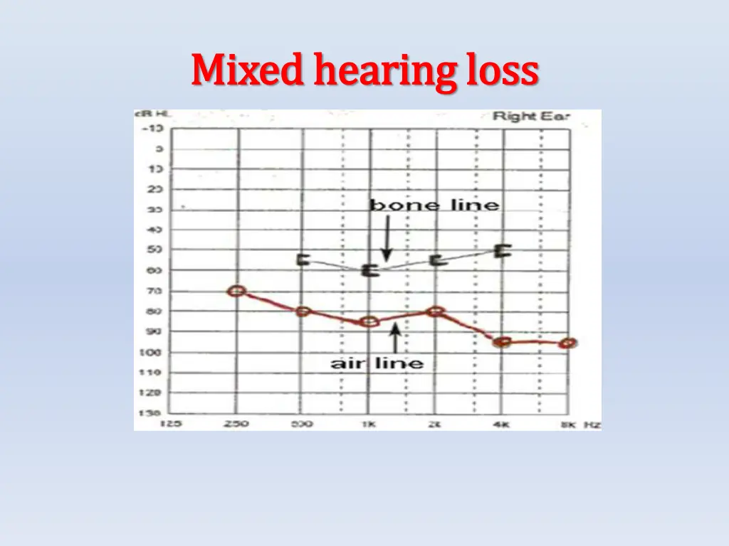 mixed hearing loss mixed hearing loss 1