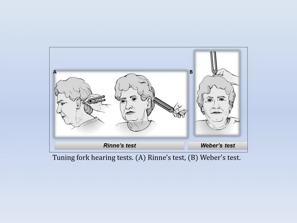 tuning fork hearing tests a rinne s test b weber