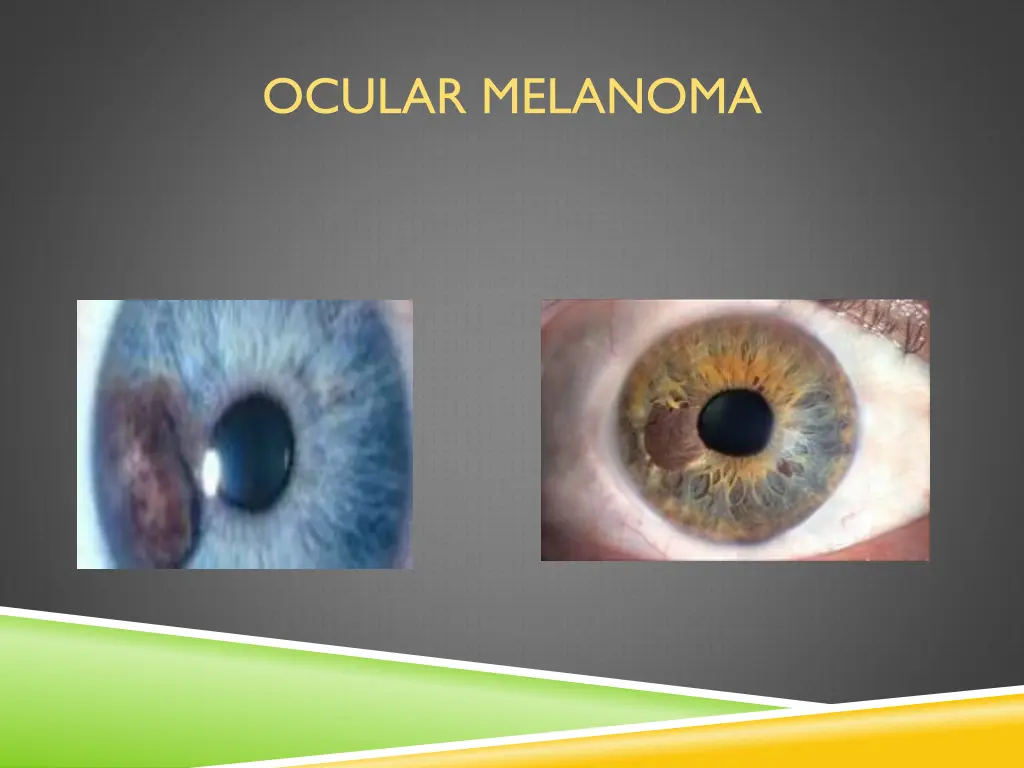 ocular melanoma 1