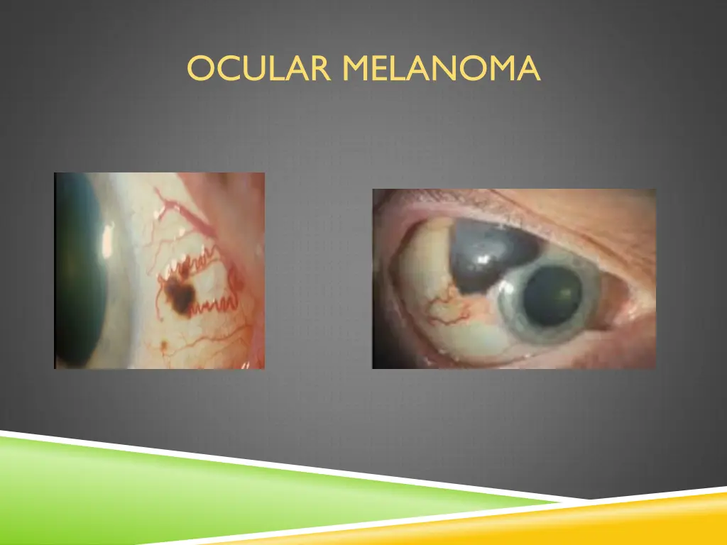 ocular melanoma 2