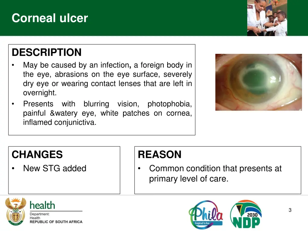 corneal ulcer