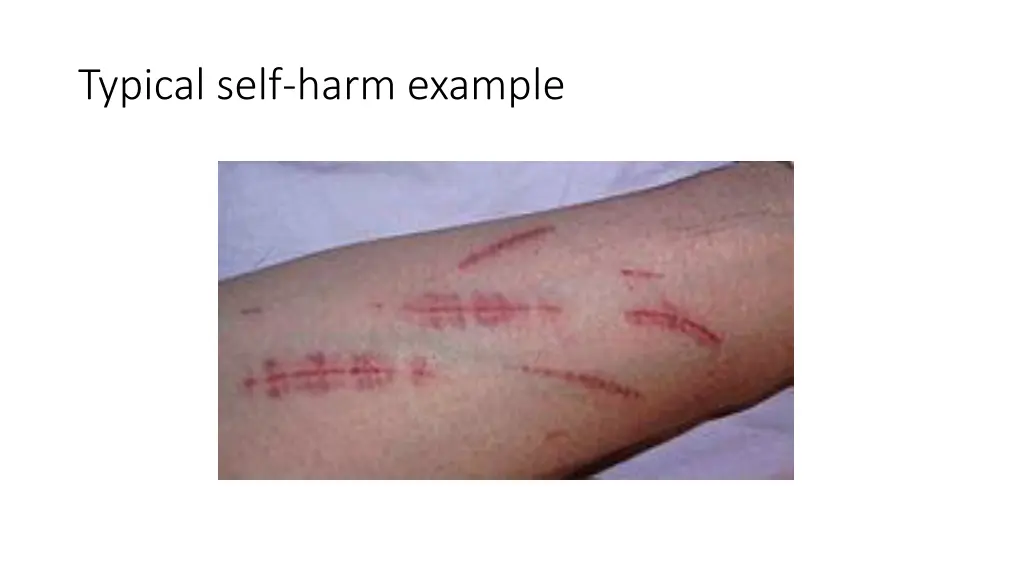 typical self harm example