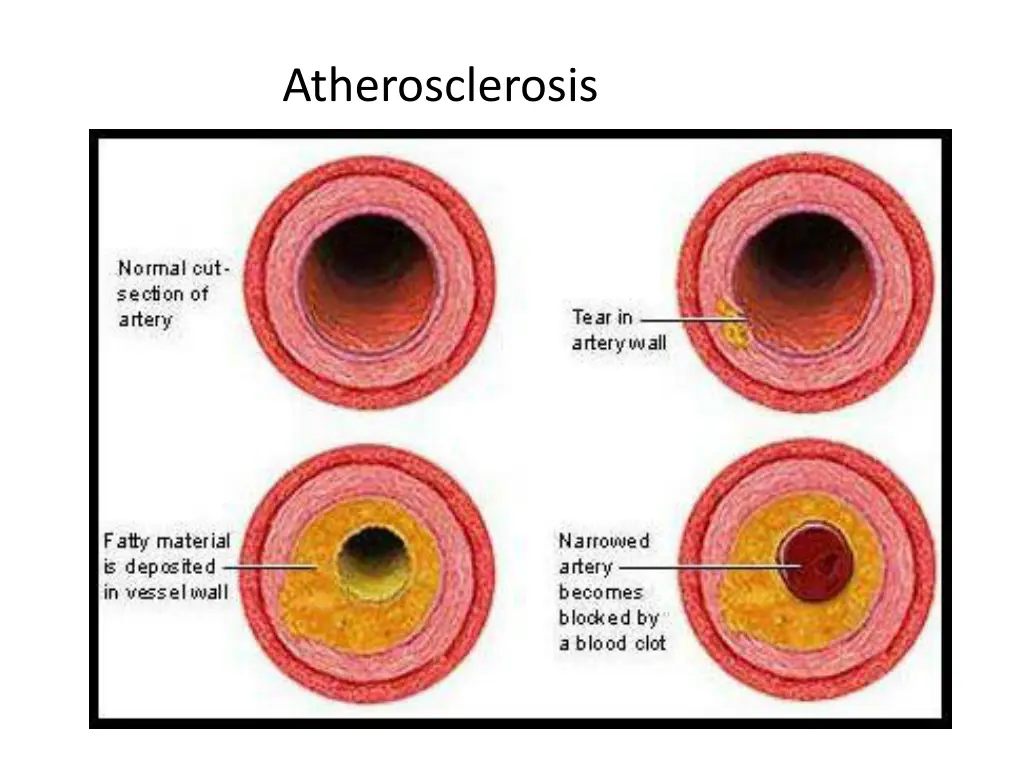 atherosclerosis