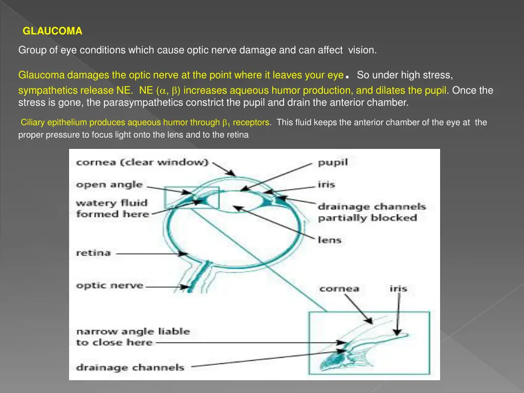 glaucoma