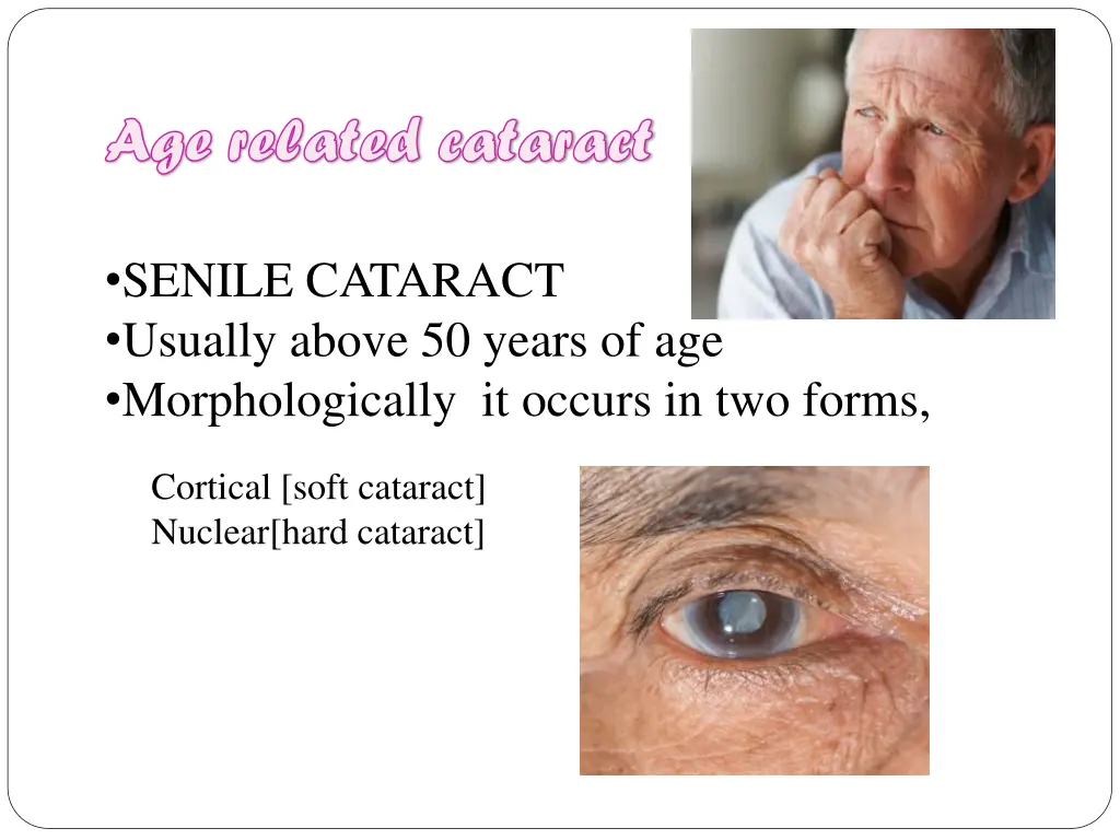 age related cataract age related cataract