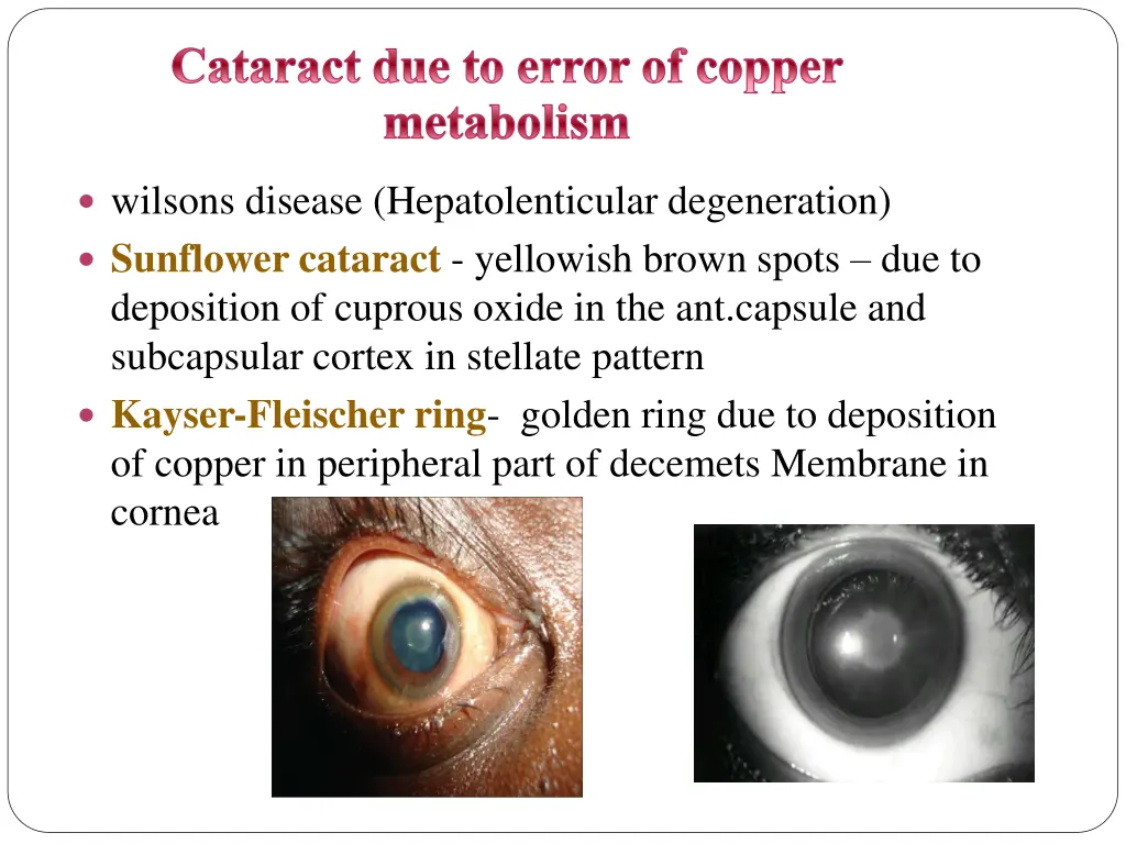 cataract due to error of copper metabolism