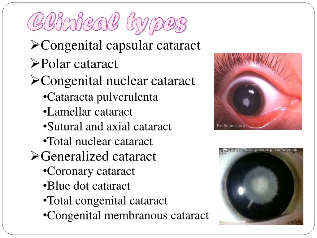 clinical types clinical types congenital capsular