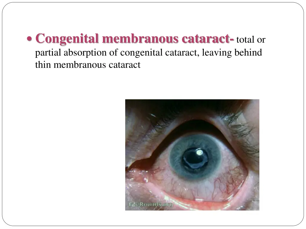 congenital membranous cataract total or partial