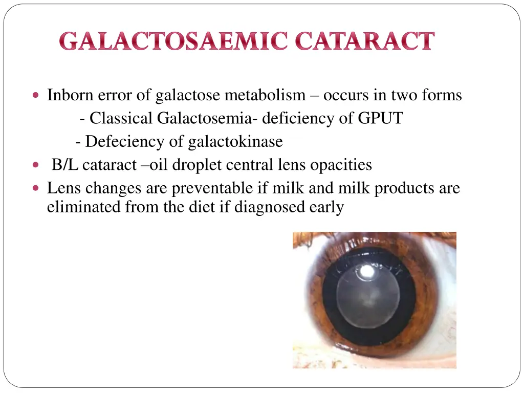 galactosaemic cataract