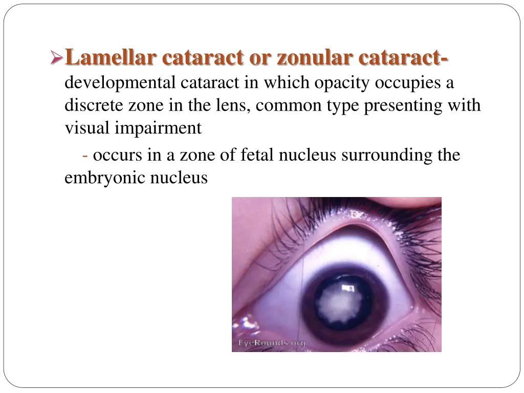 lamellar cataract or zonular cataract