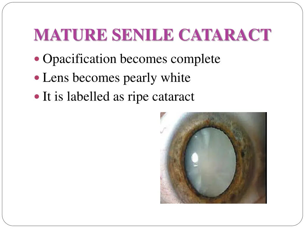 mature senile cataract